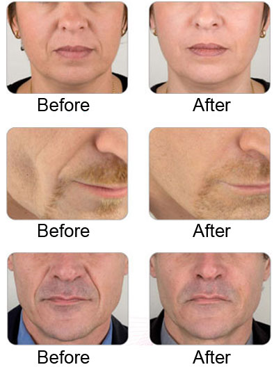 Dermal Fillers Rotherham dentist