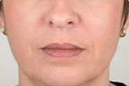 Dermal Fillers